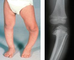 Understanding Bowed Legs in Children and Adolescents: Causes and When to Seek Help