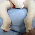 Understanding and Treating Clubfoot: Early Intervention and Effective Methods