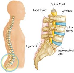 Sciatica