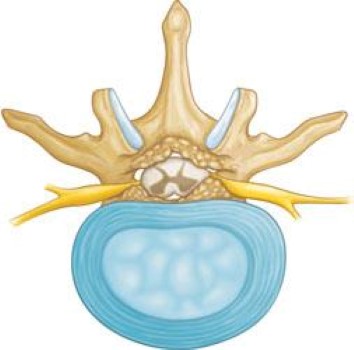 Understanding Lumbar Spinal Canal Narrowing: Causes, Symptoms, and Age-Related Risk Factors