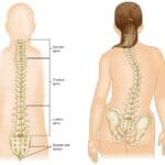 Understanding Neuromuscular Scoliosis in Children with Muscular and Neurological Conditions