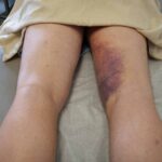 Understanding Thigh Muscle Strains: Causes, Risks, and Recovery