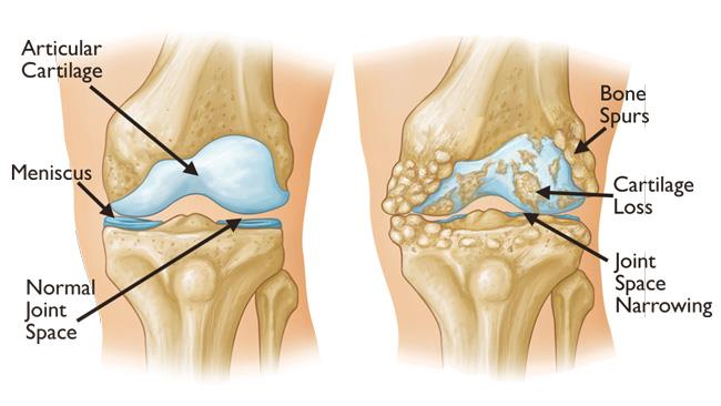 Knee Arthritis: Symptoms, Types, and Effective Management Strategies