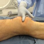 Understanding Patellar Fractures: Causes, Symptoms, and Treatment Options