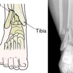 Understanding Pilon Fractures: Causes, Treatment, and Impact on Ankle Health