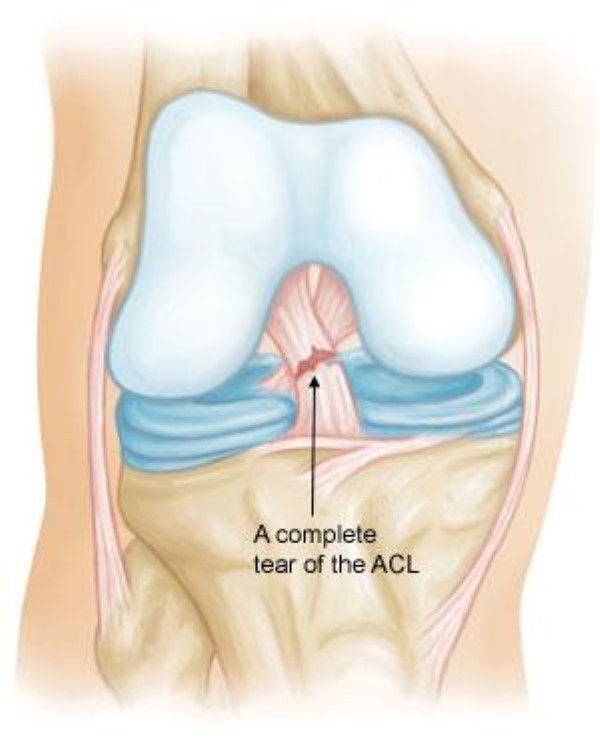 Understanding ACL Injuries: Causes, Risks, and Treatment Options