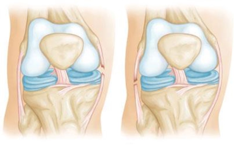 Understanding Collateral Ligament Injuries: Causes, Symptoms, and Treatment