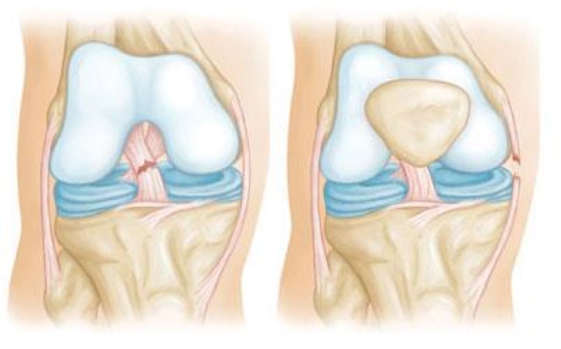 Revitalizing Movement After Combined Knee Ligament Injuries