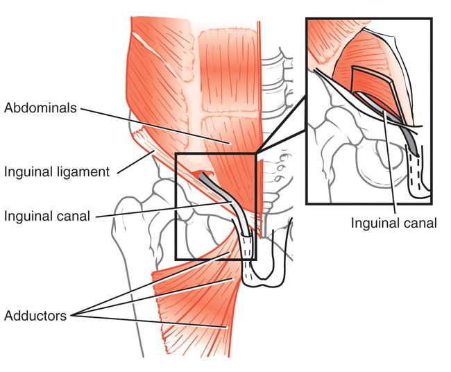 Understanding Athletic Pubalgia: A Comprehensive Guide to Sports Hernias