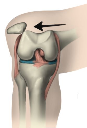 Understanding and Managing Unstable Kneecaps in Children: Causes, Symptoms, and Treatment