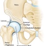 Understanding Hip Dysplasia in Adolescents: Causes, Symptoms, and Treatment Options