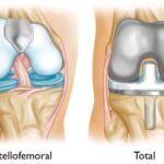 Understanding Patellofemoral Arthritis: Symptoms, Causes, and Challenges in Everyday Activities