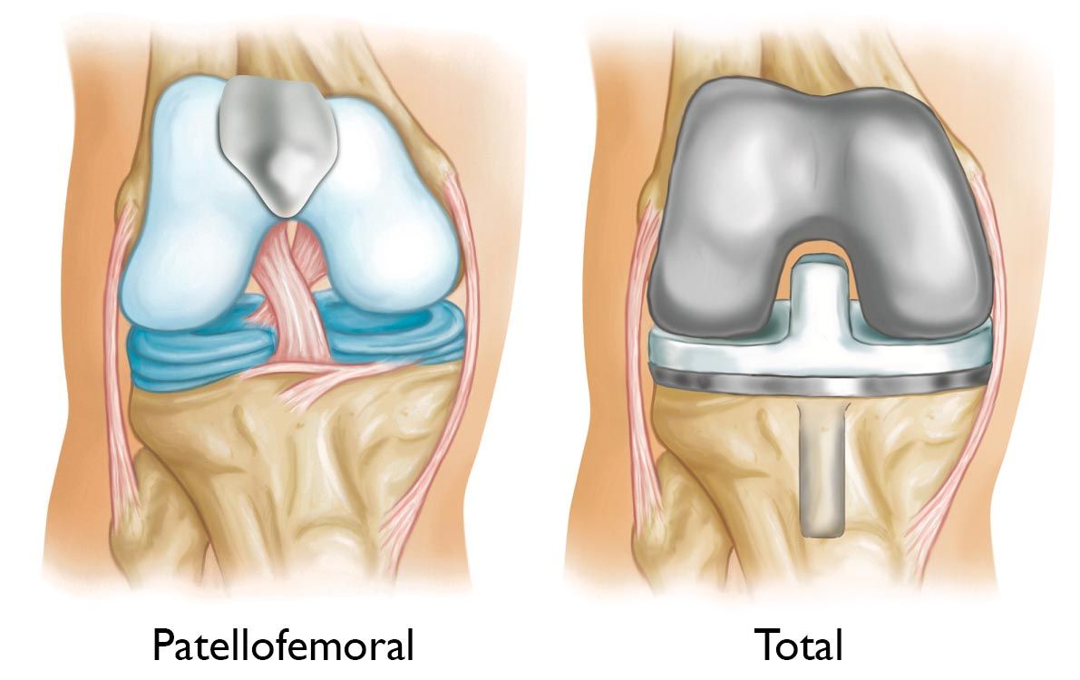 Understanding Patellofemoral Arthritis: Symptoms, Causes, and Challenges in Everyday Activities