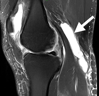 Understanding Baker’s Cyst: Causes, Symptoms, and Treatment Options