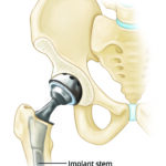 Understanding Periprosthetic Fractures After Hip Replacement Surgery