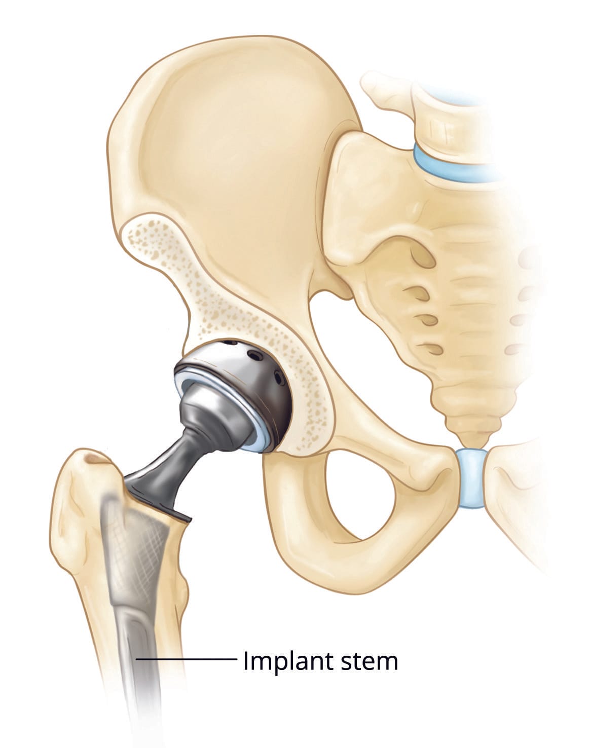 Understanding Periprosthetic Fractures After Hip Replacement Surgery