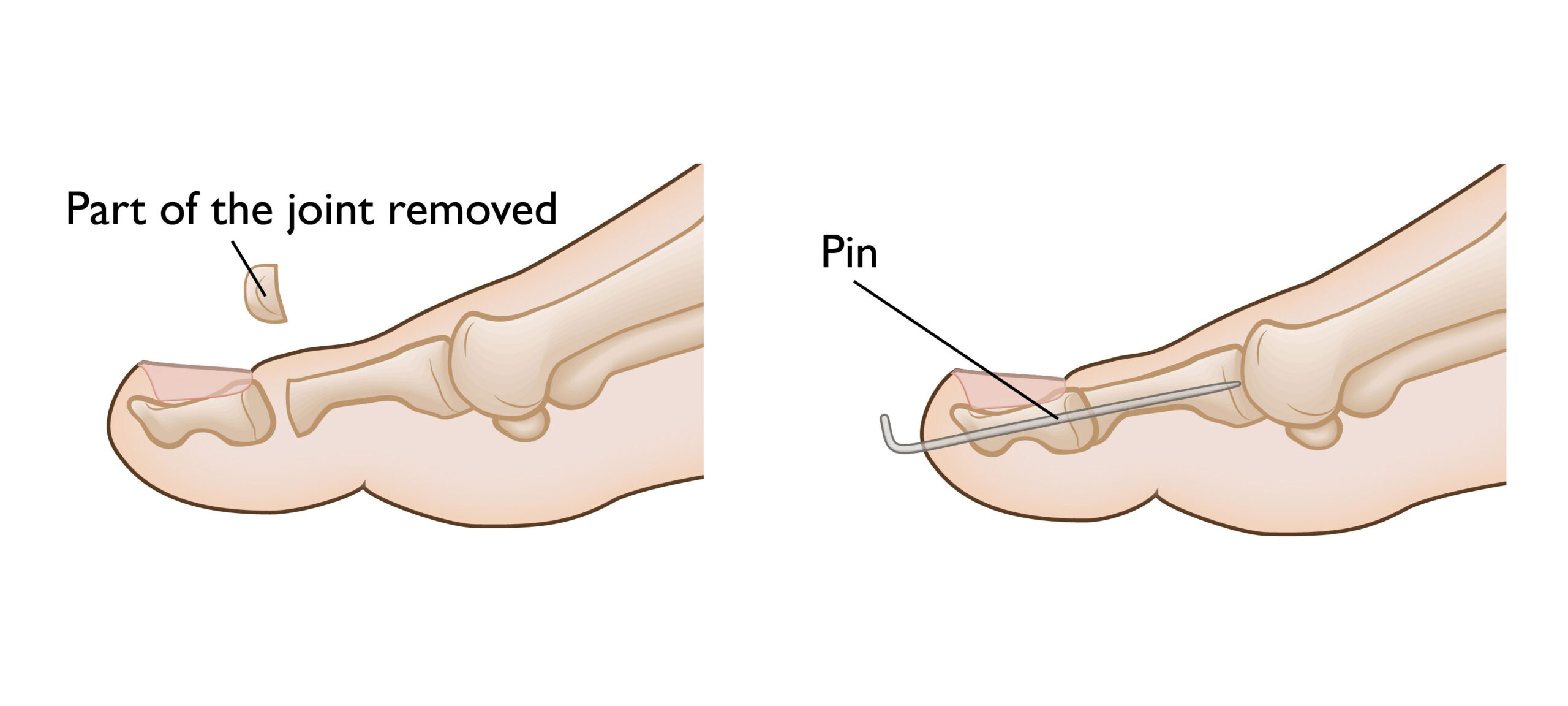 Understanding Claw Toe Causes Symptoms And Treatment Options 