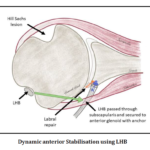 Our New Classification for Shoulder Instability- The BoTH Classification: A Guide for Patients