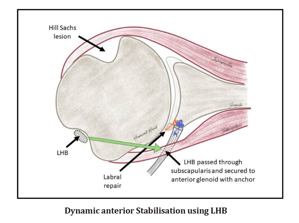 Our New Classification for Shoulder Instability- The BoTH Classification: A Guide for Patients