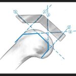 Surgical Lines in Total Knee Arthroplasty (TKA)