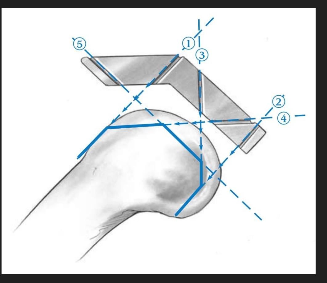 Surgical Lines in Total Knee Arthroplasty (TKA)