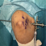 Elbow Arthroscopy: Procedure, Benefits, and Recovery