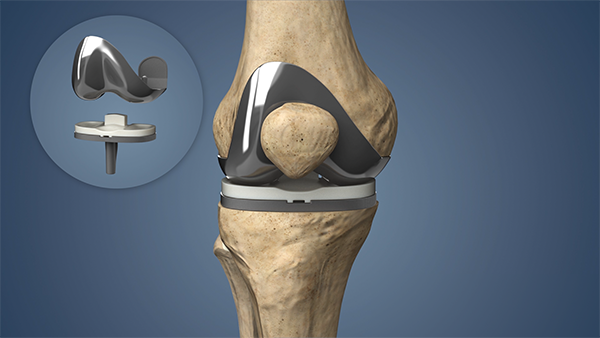 Understanding Knee Replacement Implants: Types and Benefits