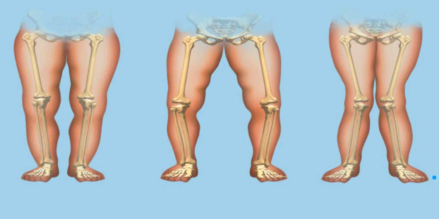 Rickets: Causes, Symptoms, Diagnosis, and Treatment