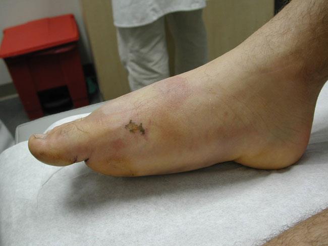 Toe and Forefoot Fractures: Causes, Symptoms, and Treatment Options