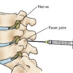 Understanding Spinal Injections: Uses, Benefits, and Risks