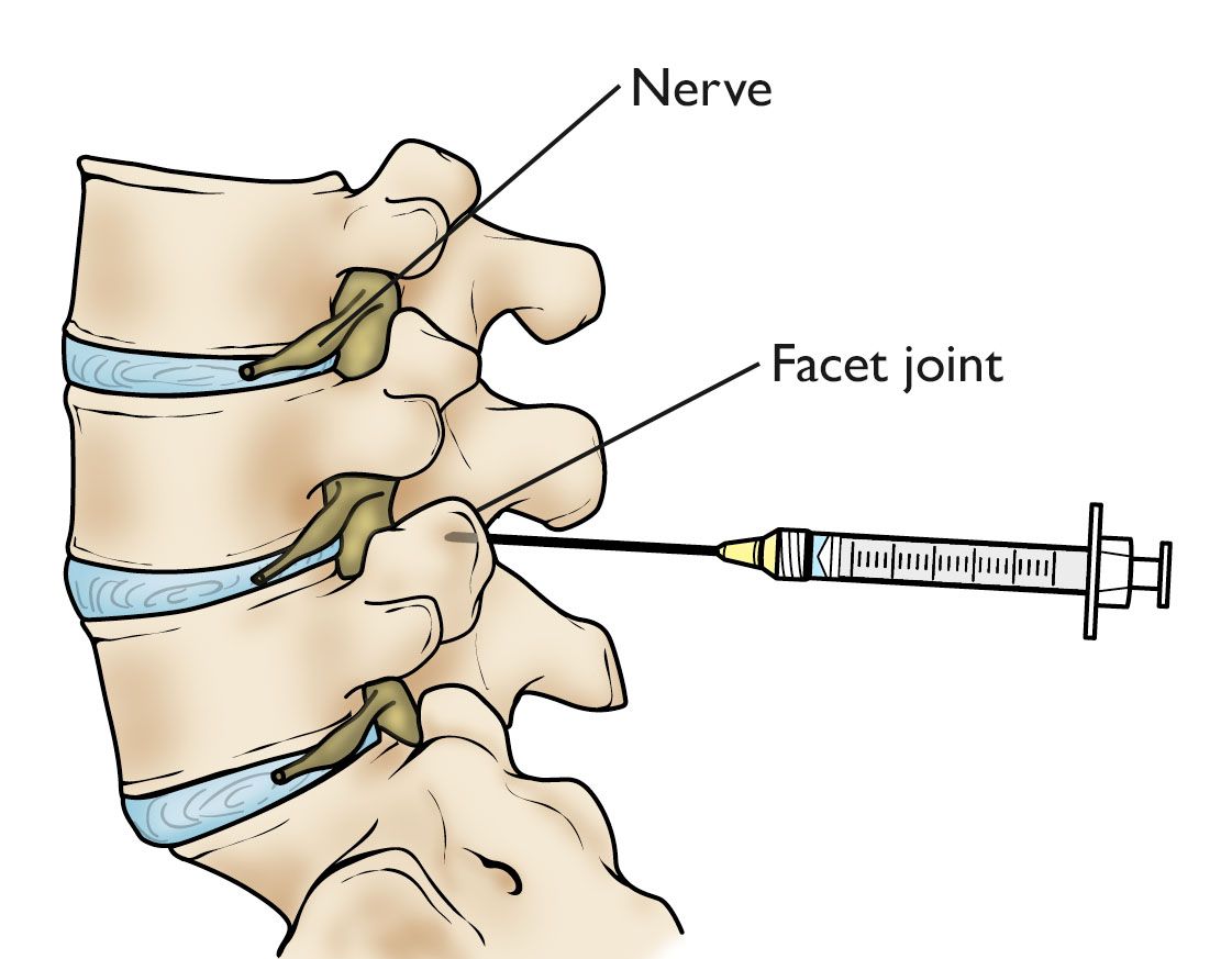 Understanding Spinal Injections: Uses, Benefits, and Risks