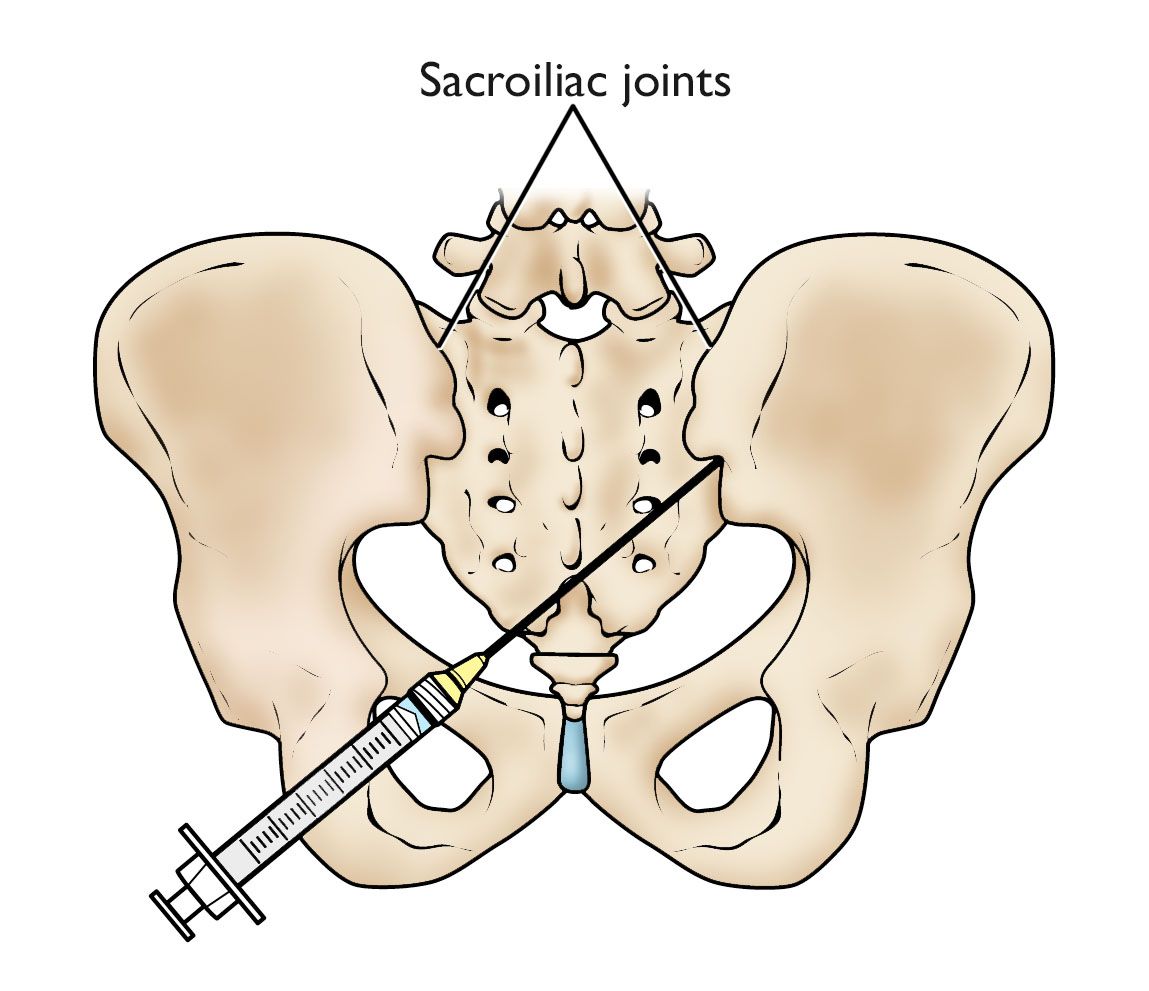 Ortho Globe | Spinal Injections: Uses and Risks