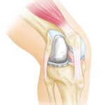 Unicompartmental Knee Replacement