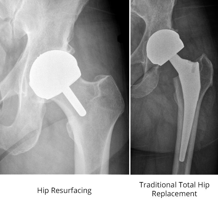 Hip Resurfacing