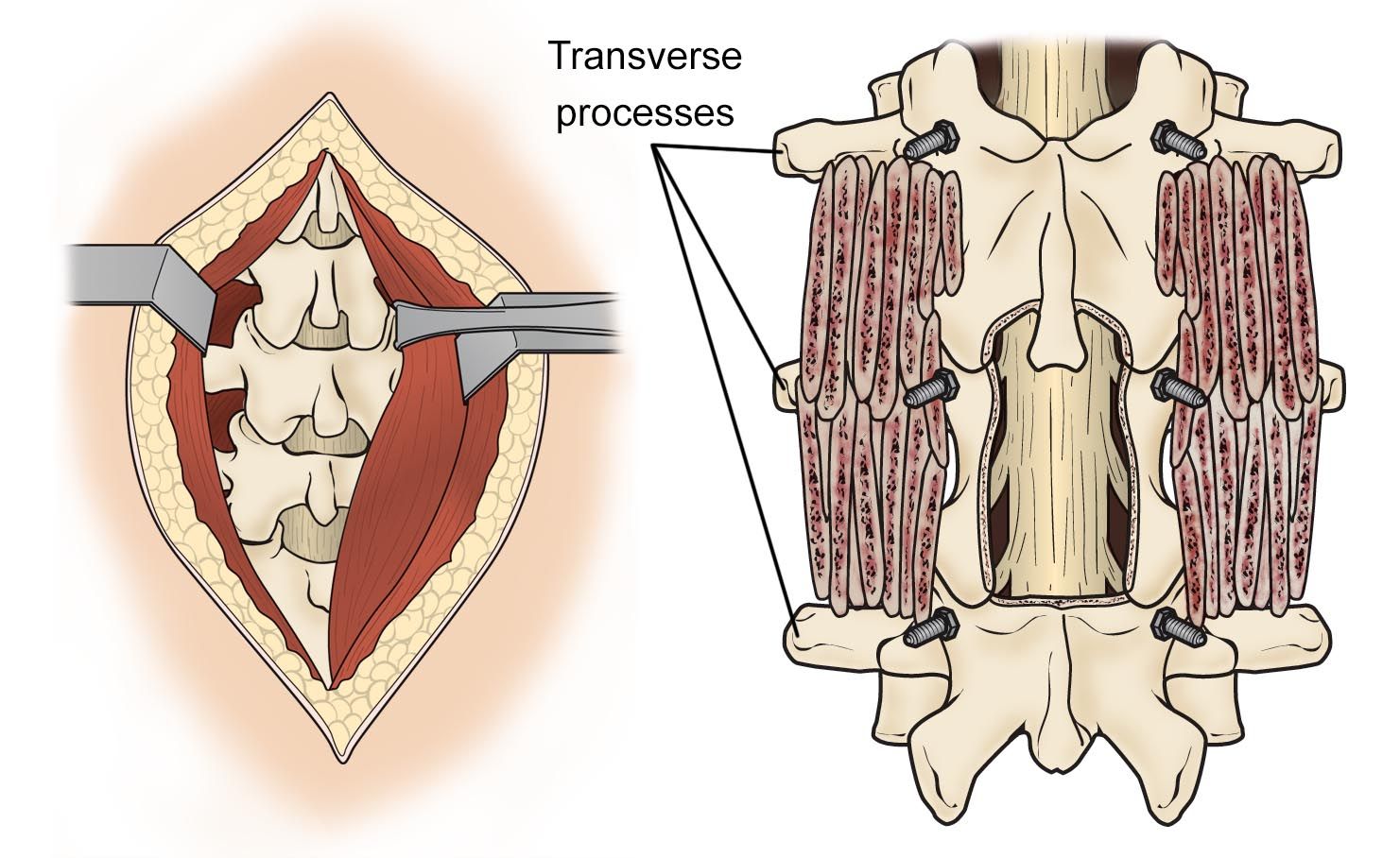 Posterolateral Lumbar Fusion: Procedure, Benefits, and Recovery