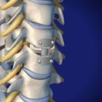 Cervical Corpectomy and Strut Graft