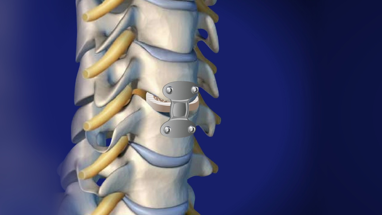 Cervical Corpectomy and Strut Graft