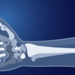 Chronic Illness and Bone Health