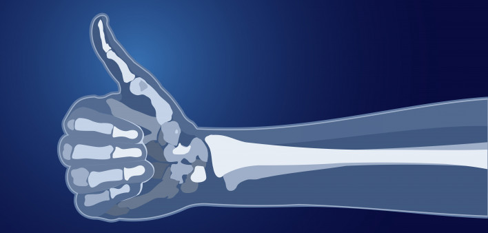 Chronic Illness and Bone Health