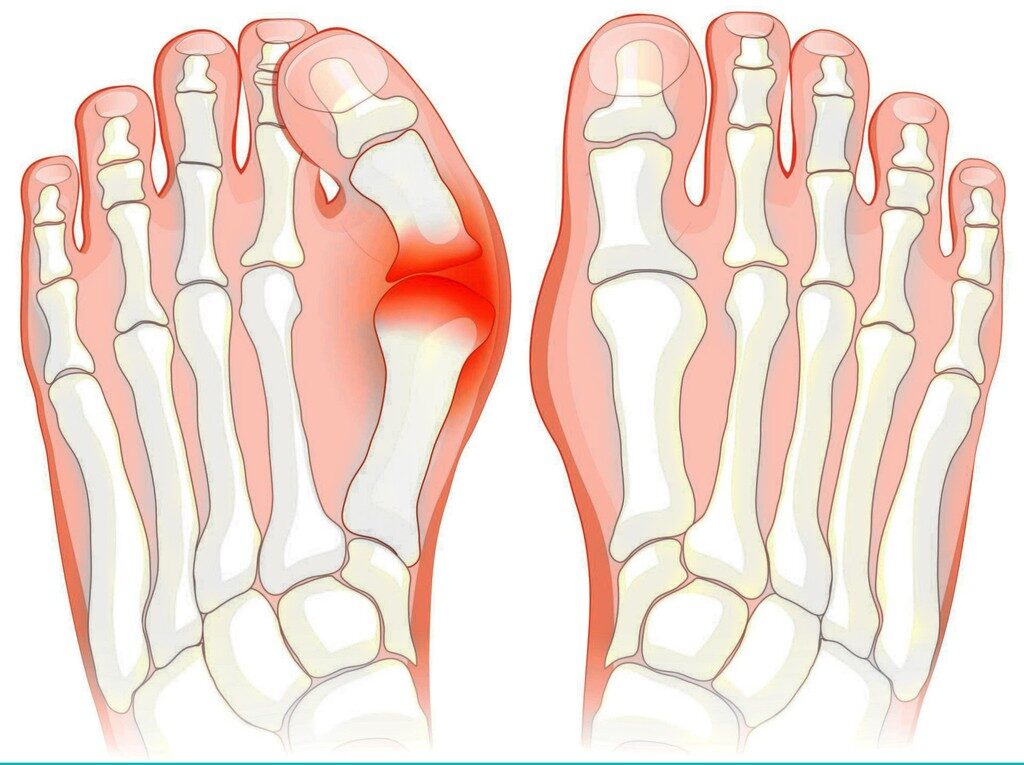 Bunion Surgery: Procedures Recovery and What to Expect