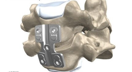 Anterior Cervical Discectomy and Fusion