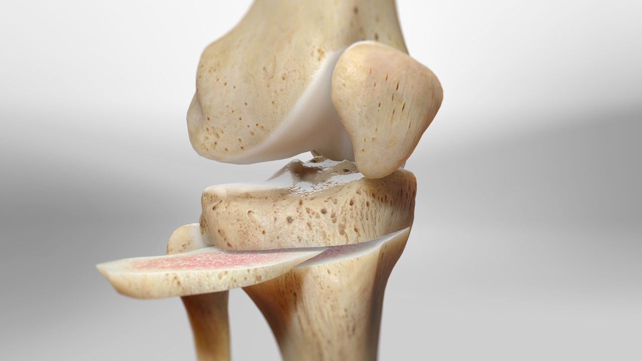 Knee Osteotomy: A Guide to Procedure and Benefits