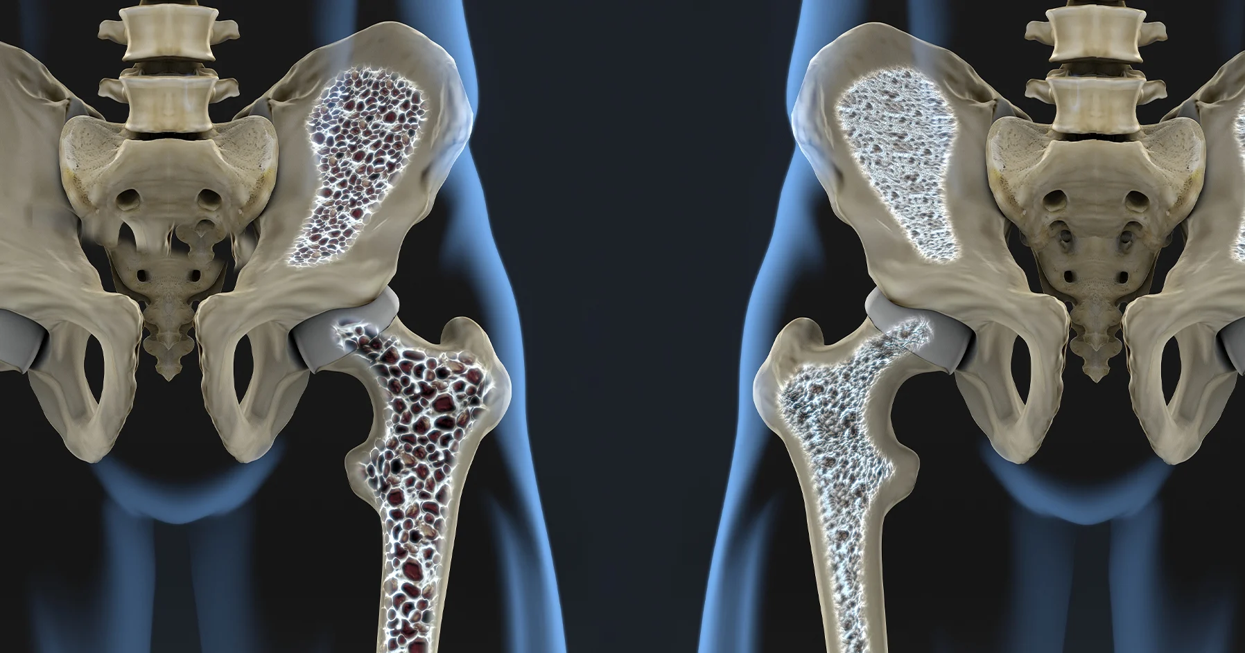 Preventing and Treating Osteoporosis: A Guide to Stronger Bones