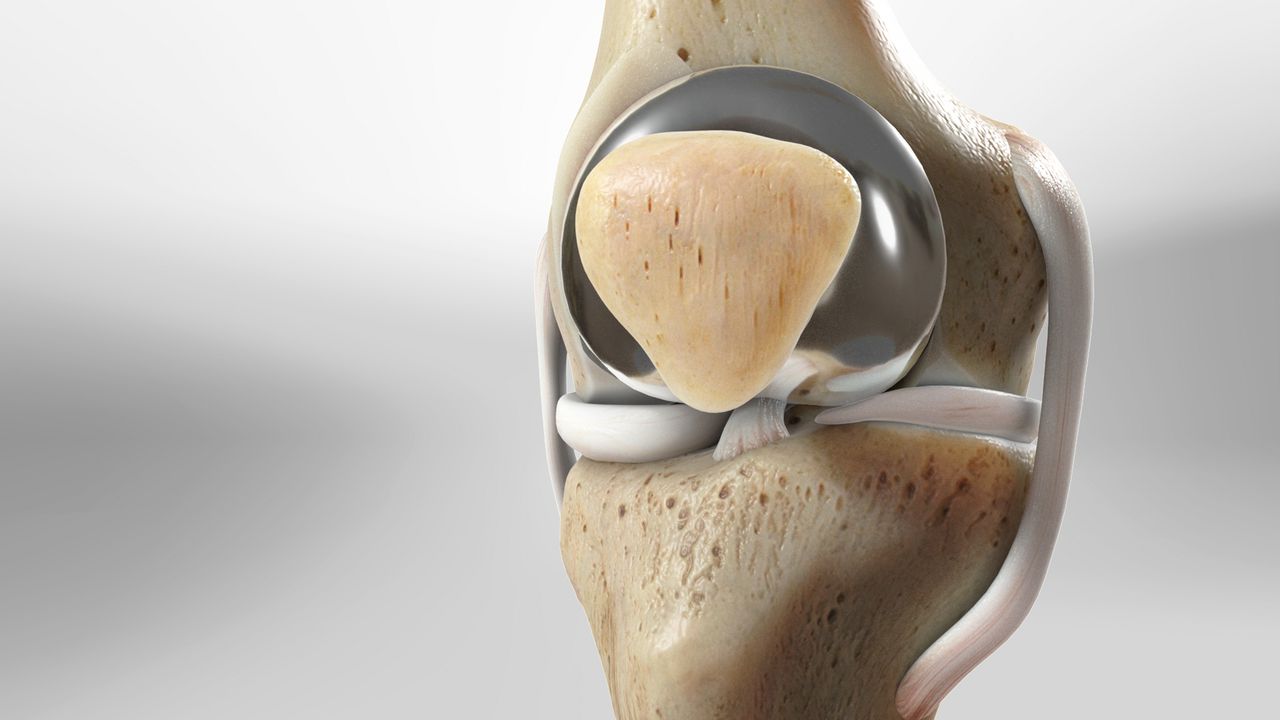 Patellofemoral Replacement: Procedure, Benefits, and Recovery