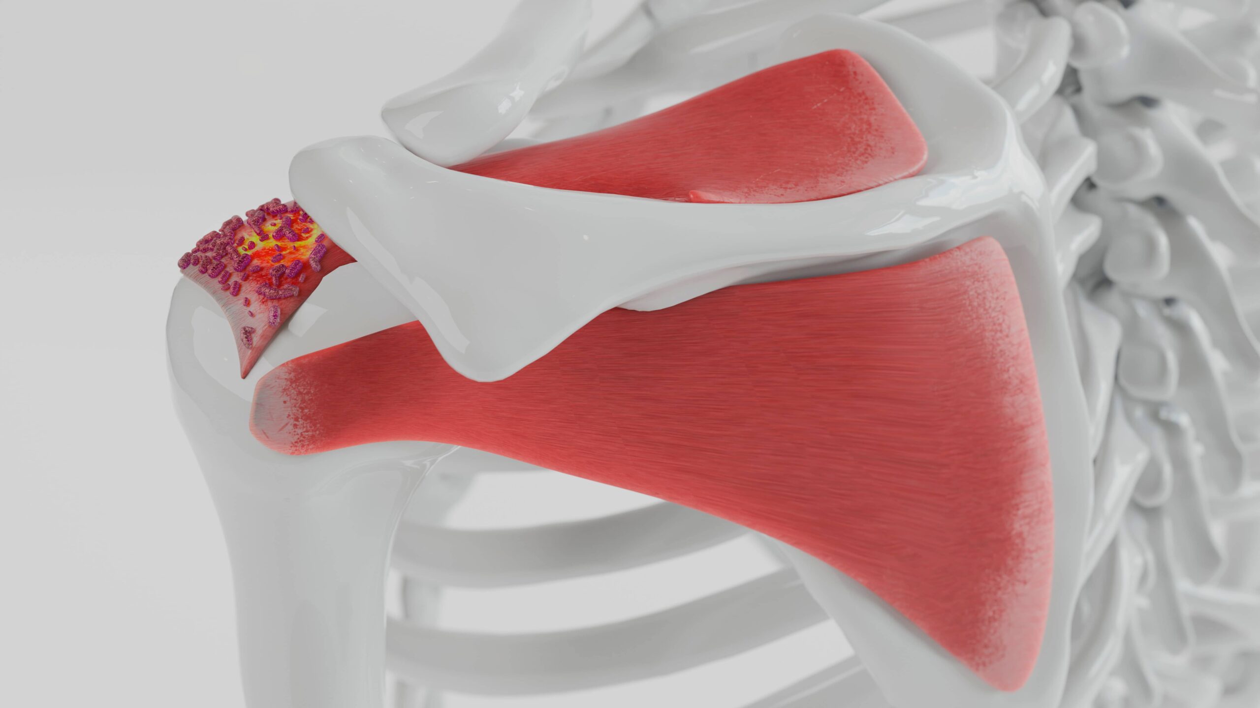 Calcific Tendonitis of the Shoulder