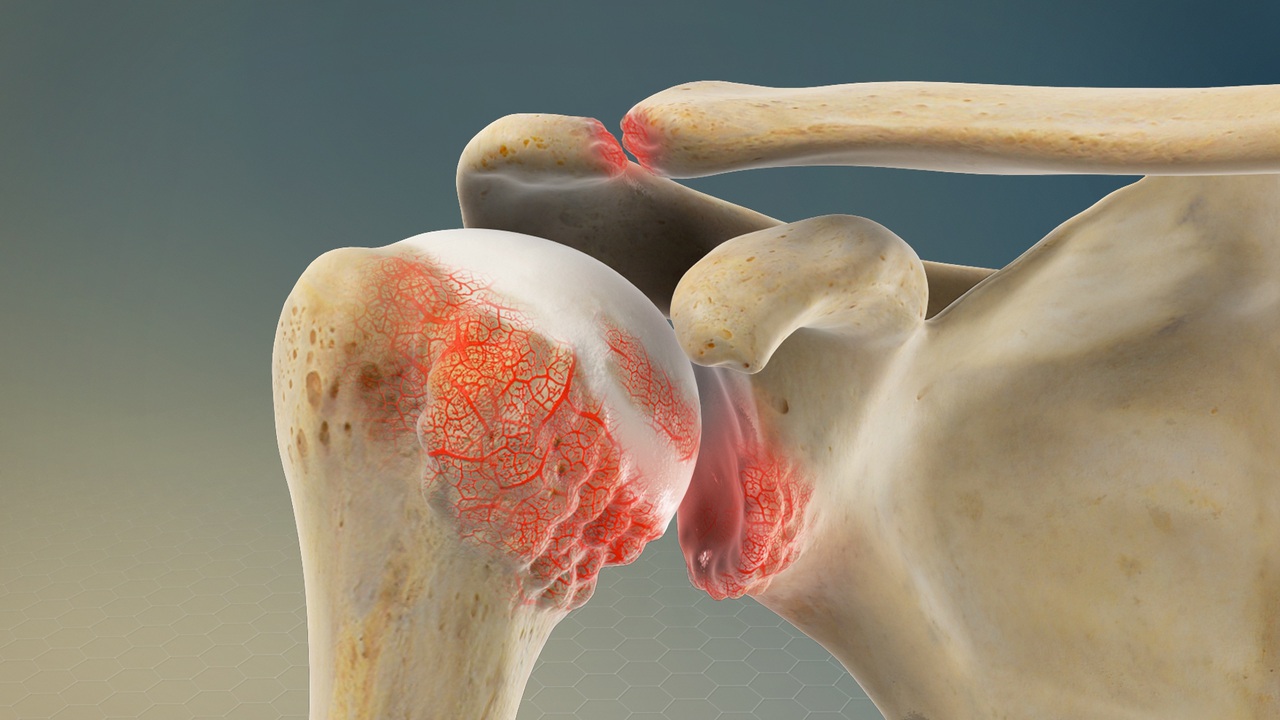 AC Joint Osteoarthritis