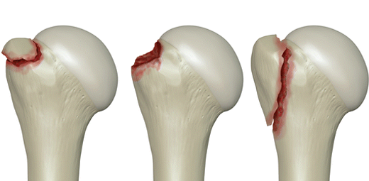 Greater Tuberosity Fractures