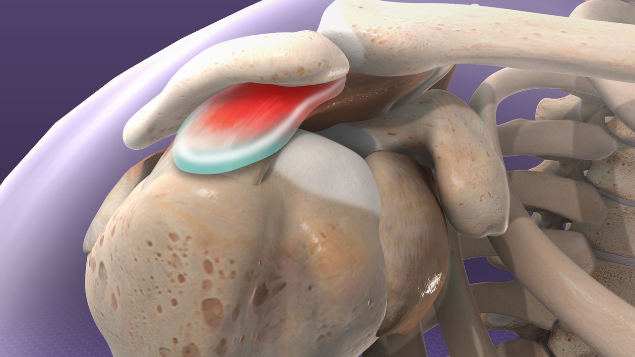 Impingement Syndrome