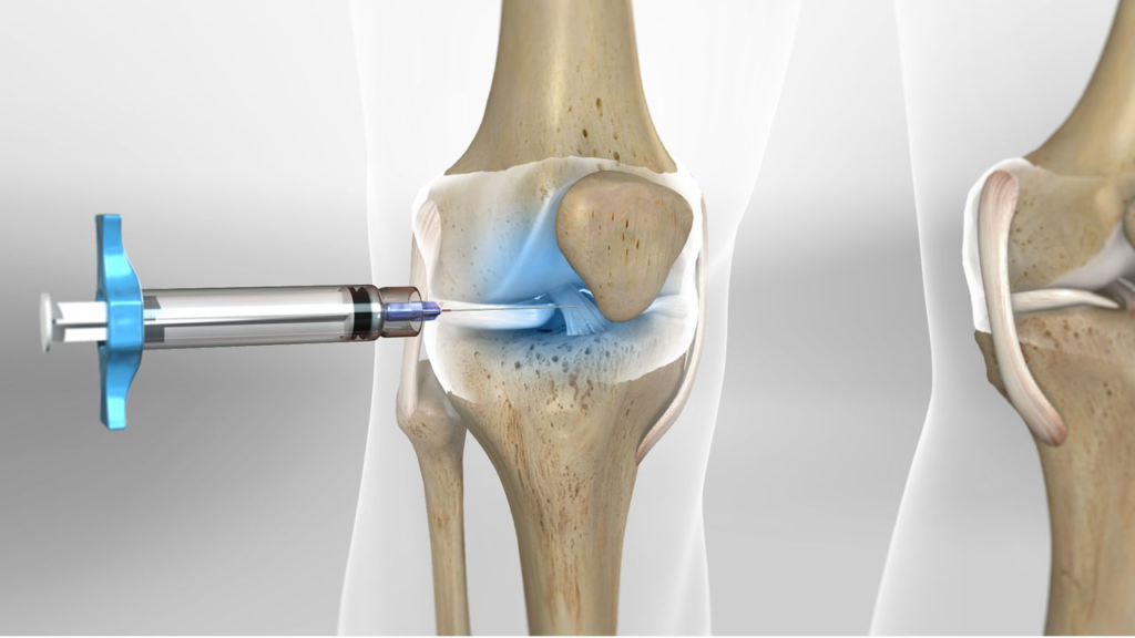 Joint Injections for Arthritis