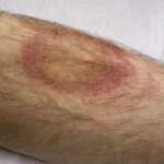 Lyme Disease